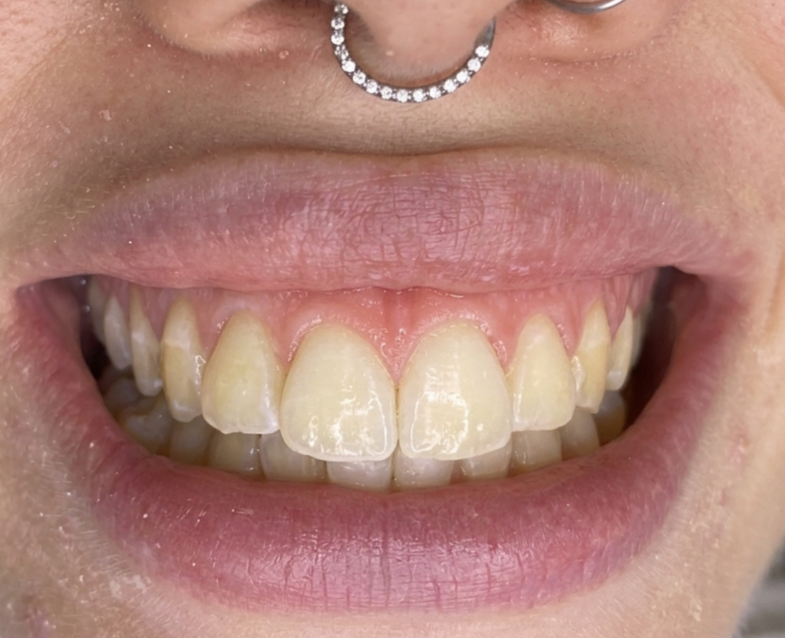 Antes do clareamento dental