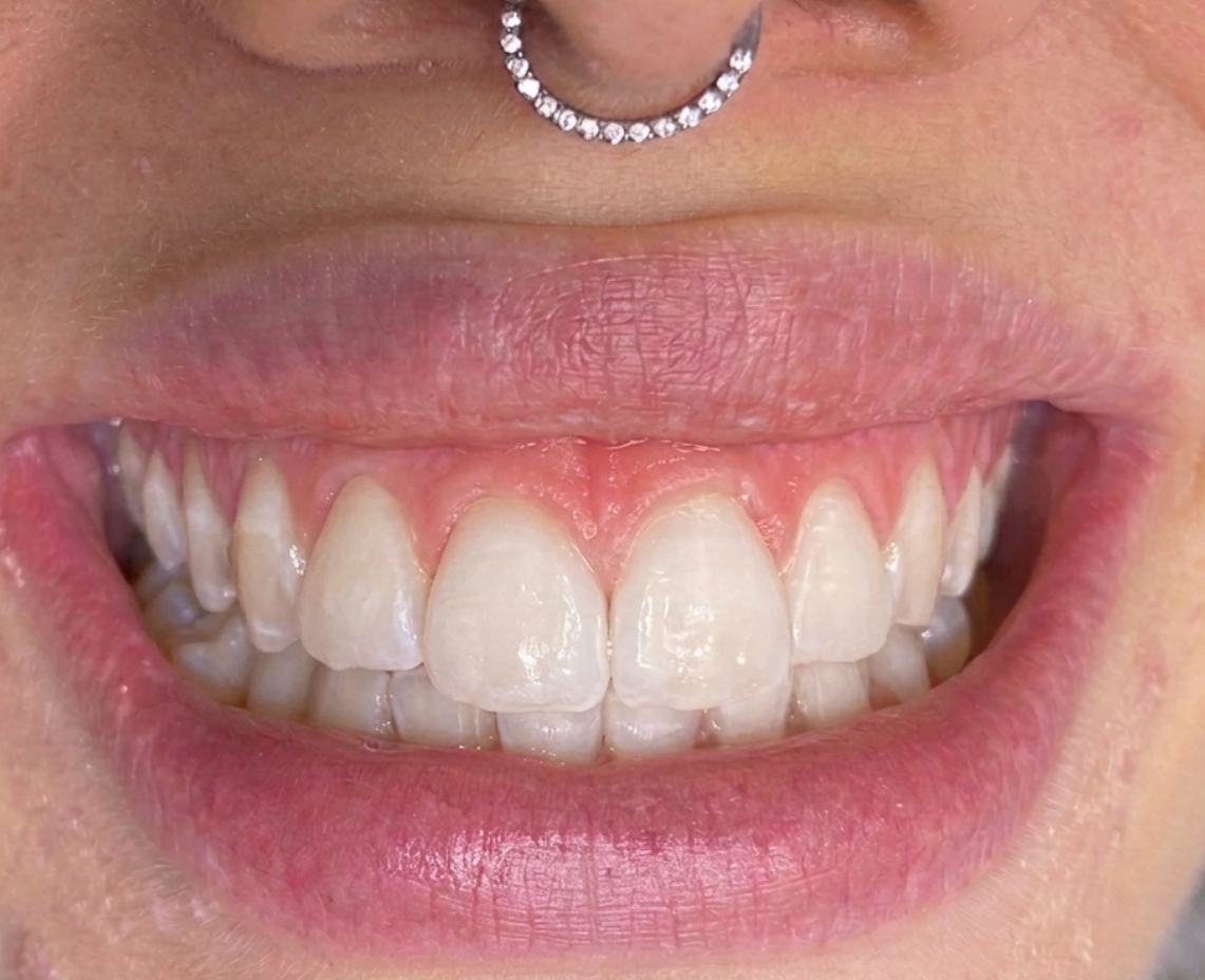 Depois do clareamento dental