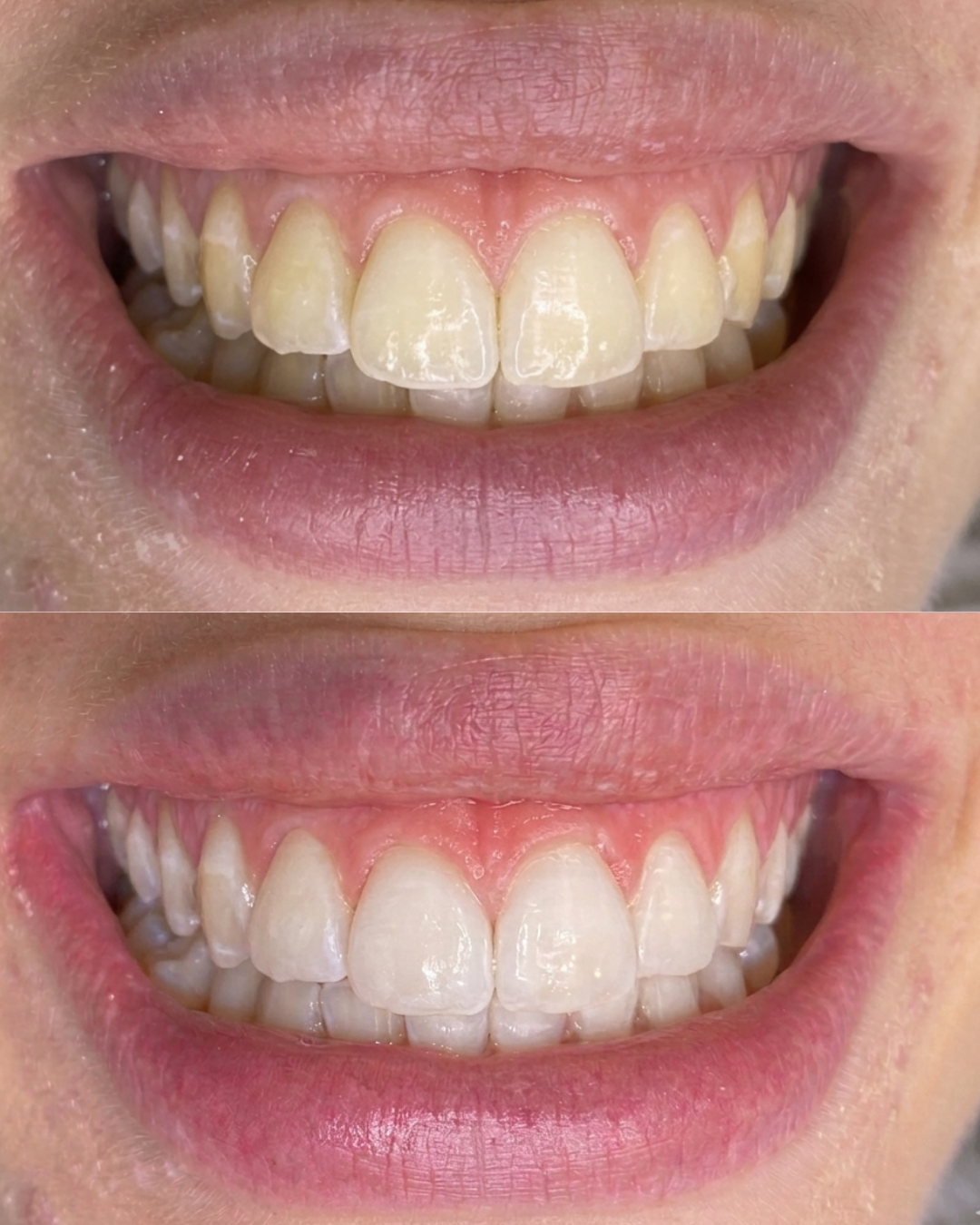 Resultado real de clareamento dental 2