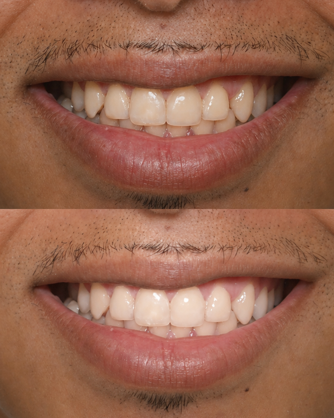 Resultado real de clareamento dental 3