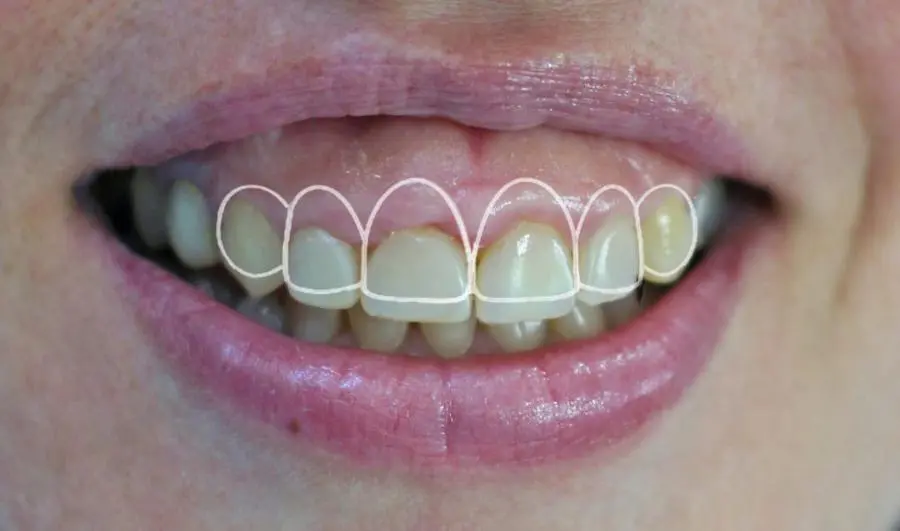 Gengivoplastia: quando é indicada e como funciona o tratamento