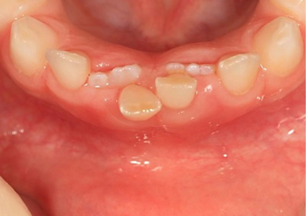 Dente de leite que não caiu: o que é retenção prolongada de dente decíduo?
